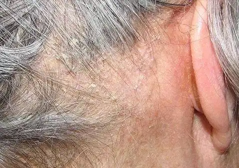 如何区分头皮屑和头皮牛皮癣银屑病真实对照图解-中华银屑病网