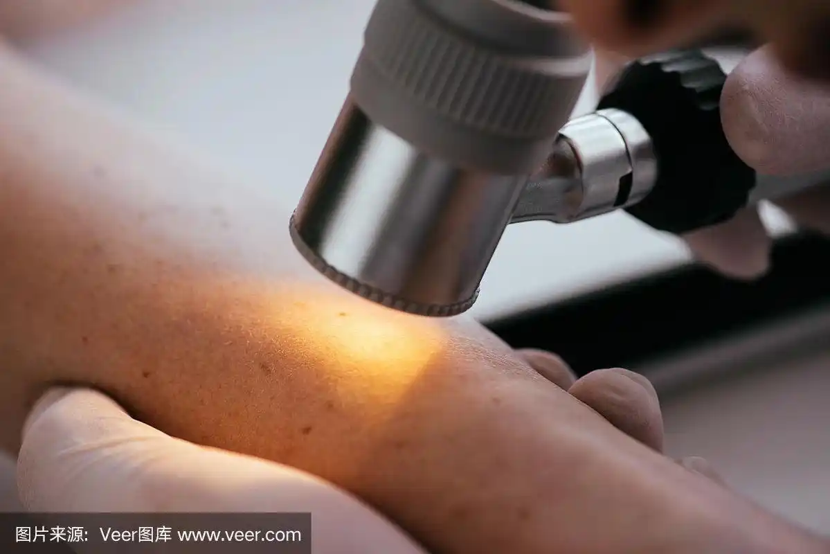 近距离观察皮肤科医生在检查女性黑色素瘤时手持皮肤镜