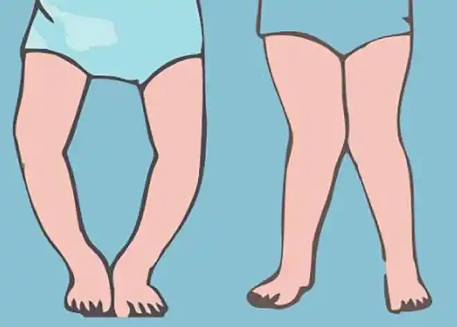 为何宝宝容易患上佝偻病?"鸡胸"病应该如何进行治疗?(下)