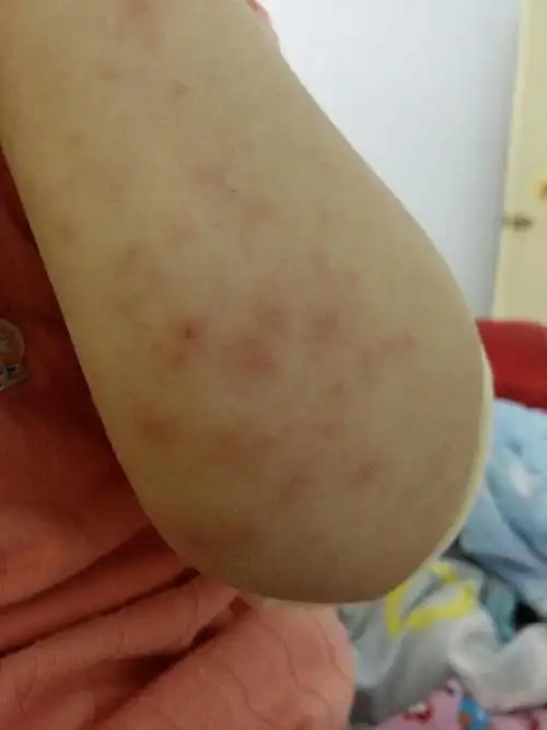 宝宝被传染疥疮,大多数是父母粗心大意导致的