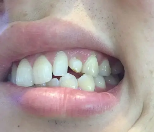 我今年24岁!这颗小牙是一颗乳牙,不疼也没什么感觉!