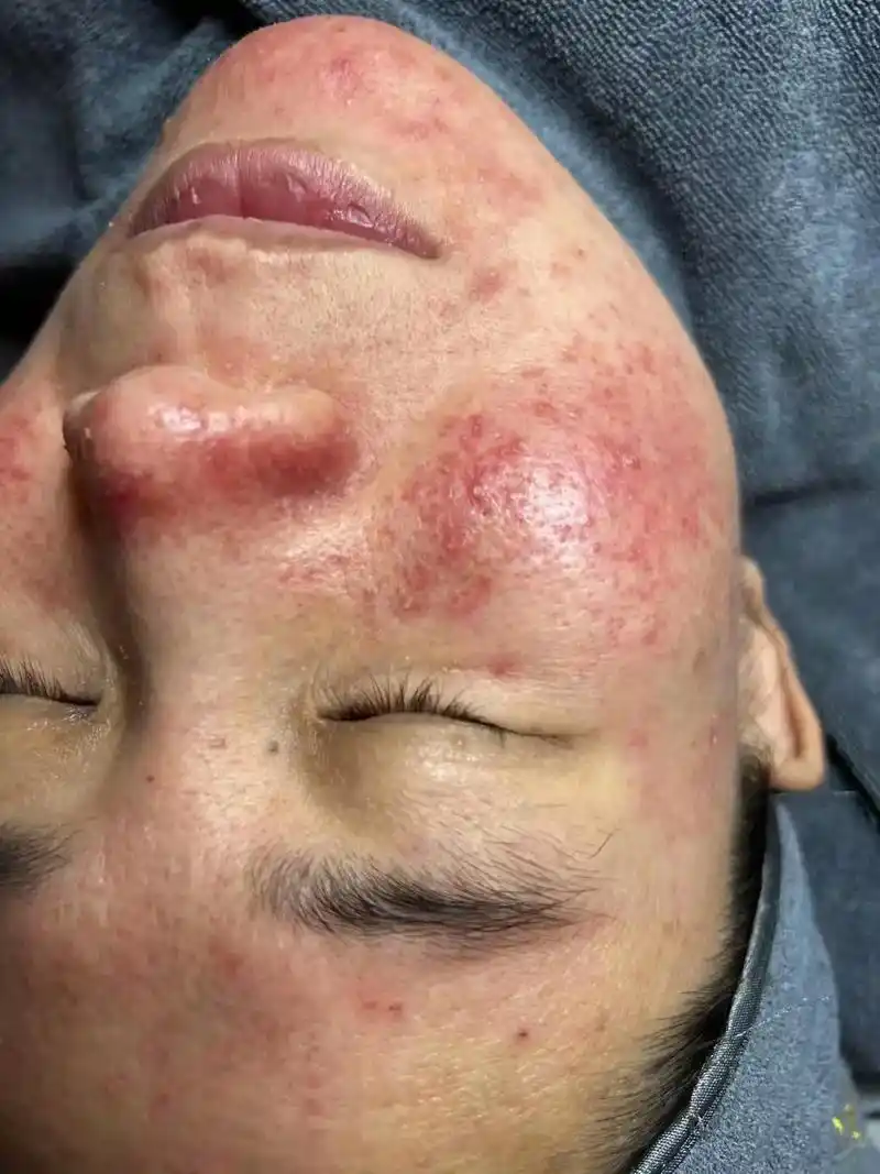 专治激素脸痘痘饥牛皮藓顽固性皮肤