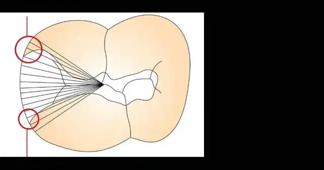 2.  窝洞边缘预备的问题