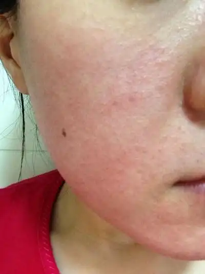 漳州过敏医院_漳州治疗过敏哪家医院好_漳州治疗过敏最好的医院/排行