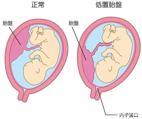 胎盘几个月位置才固定