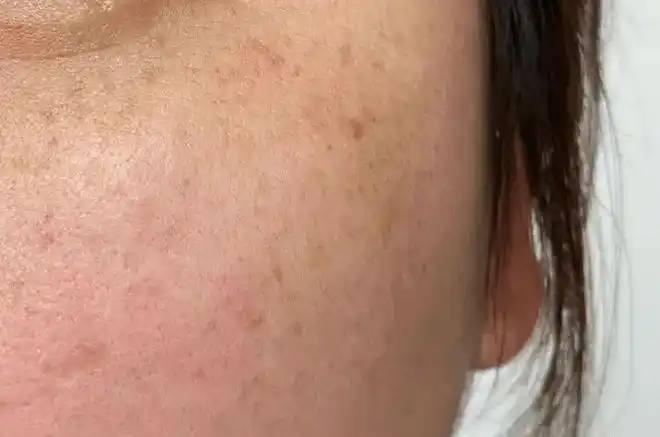 脸上斑点越来越多很难看用这个牙膏擦脸小技巧皮肤白皙又光滑