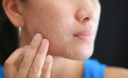 脸上去角质有哪些误区,再不知道就晚了