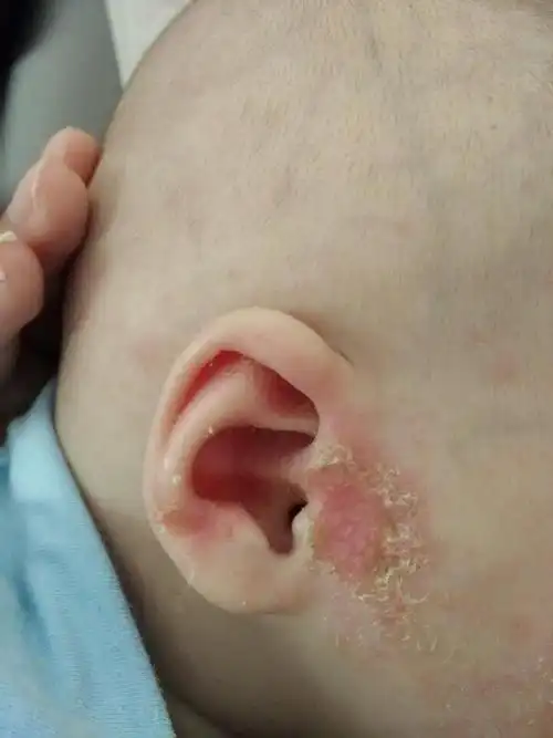 宝宝3个多月,湿疹反反复复,耳朵里面湿湿的有股味道,刚结珈又复发,看