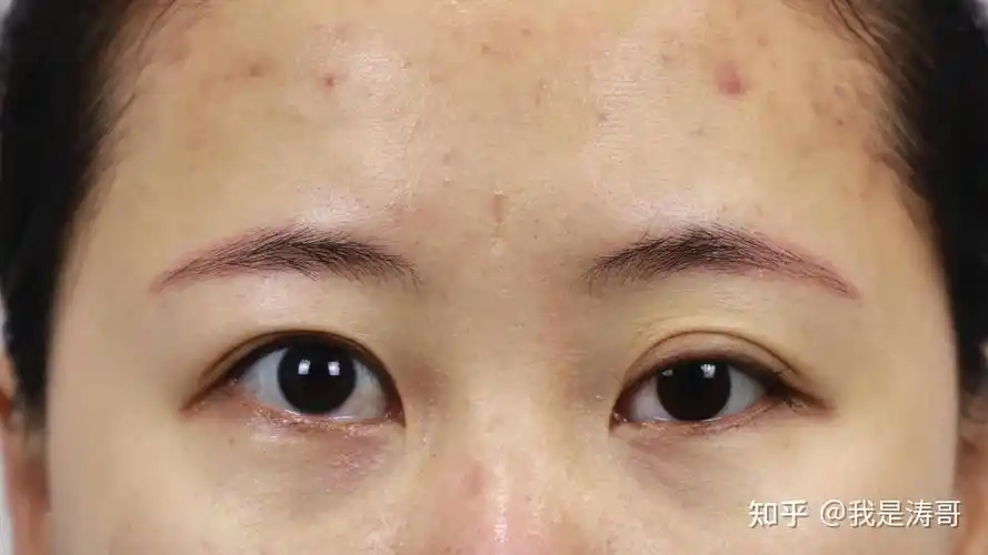 为什么眼睑肌无力的人做了双眼皮后像变了个人一样?