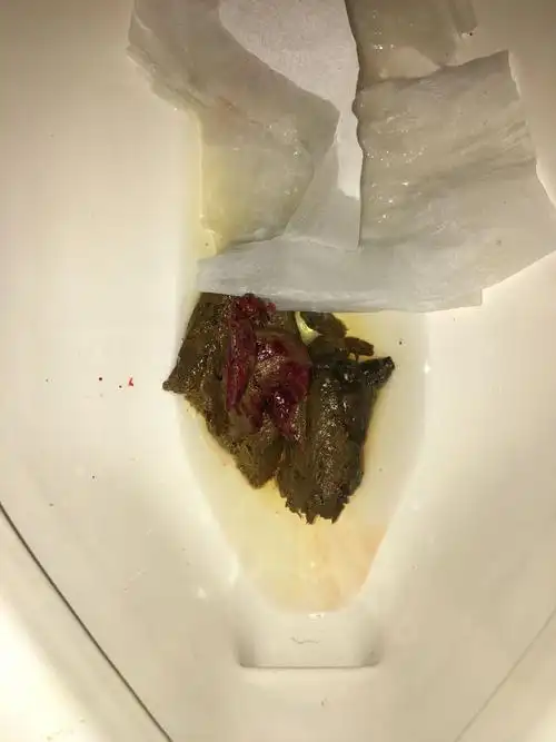 胃出血还是肠道还是肛门裂开导致出血好像只有拉大便时才有但昨天没有