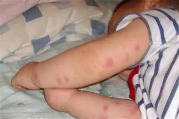 前段时间,果果的宝宝头上长出了几颗红 疙 瘩,她以为被什么小虫子咬了