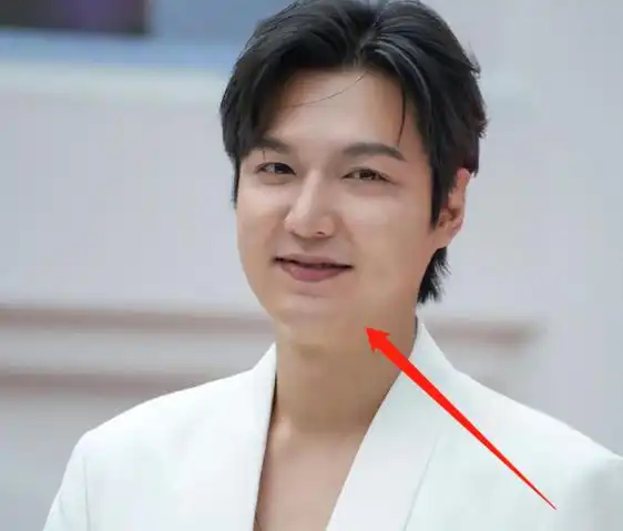 李敏镐发福浮肿大变样,脸跟脖子融为一体,疑整容后遗症爆发