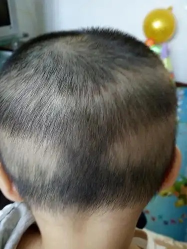 十月宝宝枕秃怎么办