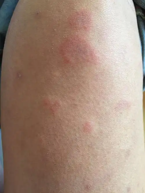 两个月前突然起的疙瘩 去医院说是皮肤过敏 可以吃利敏片 也可以不吃