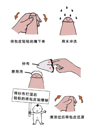 高考结束了,要不要给孩子割个包皮?