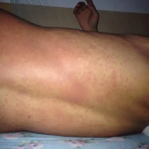 有强烈烧灼感!头昏,咽喉有痰,起因也不清楚,已经三天了!医生说是过敏!