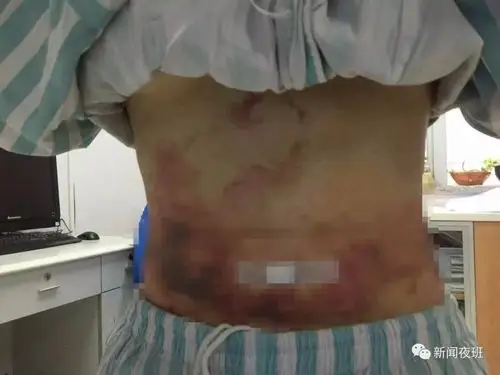 可怕南宁一友女为变美做吸脂手术腰部竟出现大片淤黑淤血