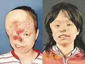 德国医生为毁容中国少女整形 效果令人惊叹(图)