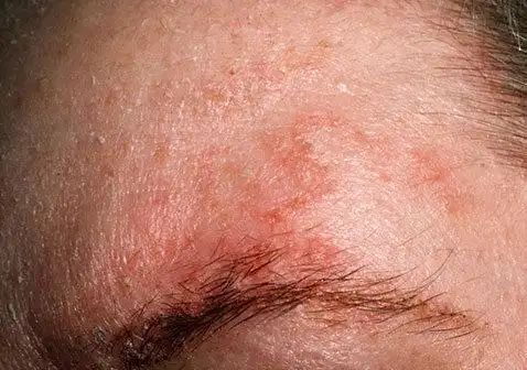 脸上眉毛区域脂溢性湿疹的发展脸上脂溢性湿疹是由于神经内分泌紊乱