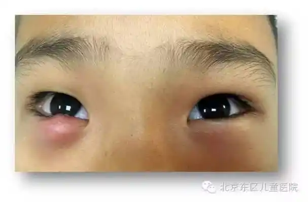 家长必读:眼部霰粒肿与麦粒肿区别
