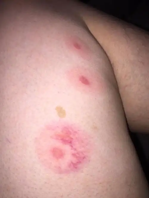 昨天发现被跳蚤咬了三个红包(肉色的圆圈是我的胎记),但是这次跟往常