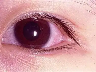 咽结膜热眼睛发红有红血丝图