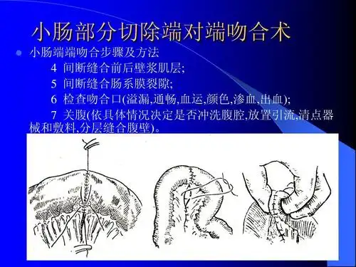 小肠部分切除端对端吻合术ppt