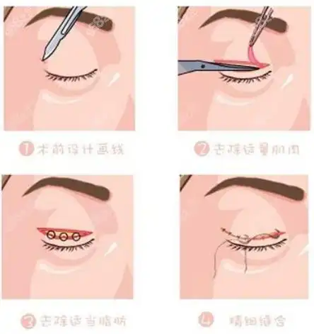 冯显雅医生做眼修复手术过程