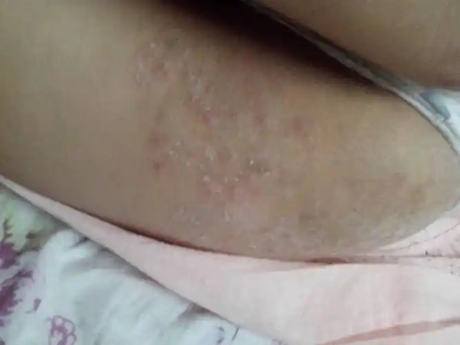 问答首页  为您推荐: 其他回答 病情分析: 这位朋友您好,考虑湿疹