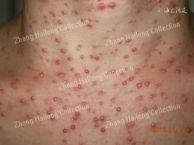 前胸后背的叫毛囊炎,头部叫脂溢性皮炎