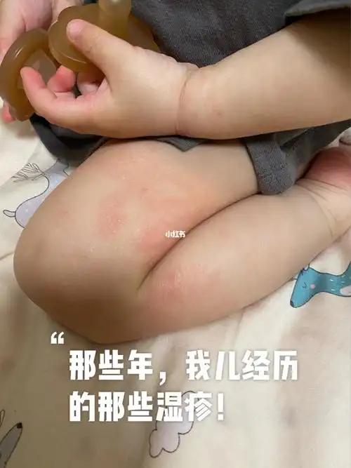 妈妈的玻璃心_湿疹_宝宝湿疹_艾维诺怎么样_红疹_过敏_面霜_宝宝湿疹