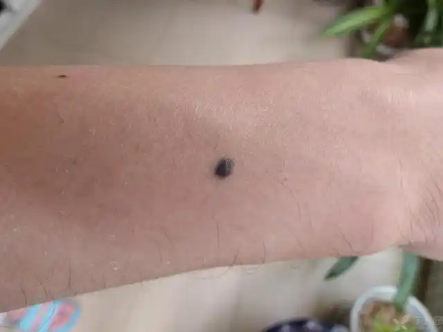 【请教】手臂上的痣