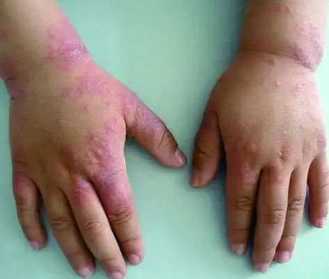 100种皮肤病图片对照图(皮肤病图片对照大全 查看图片)-健康-公司创