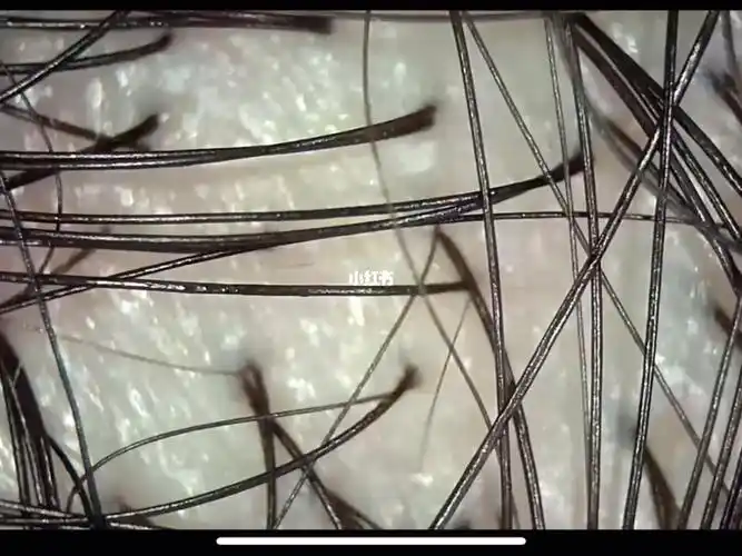 在50倍头皮测试仪下的健康状况