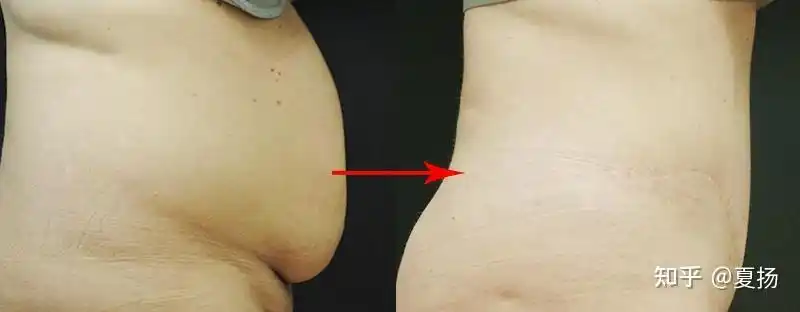 产前小蛮腰产后肚子大皮肤松怎么恢复身材才有用