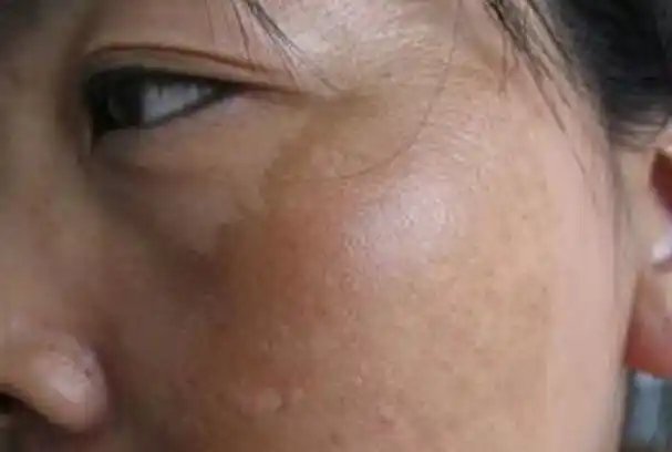 黄褐斑又称肝斑,蝴蝶斑,妊娠斑,长发生于面部或孕期女性的面部,其边界