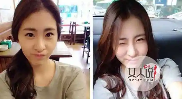 张碧晨整容前后张碧晨整容前后照片对比昔日丑女秒变大美人判若两人