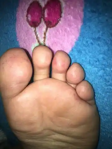 孕晚期脚底长了好多小红点