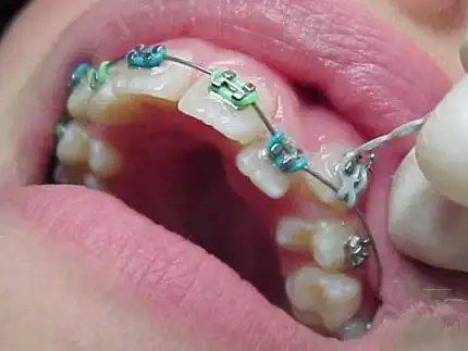 虎牙长得太丑了好想直接拔掉啊