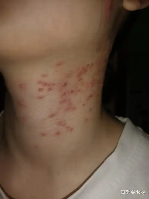 医生说是马拉色菌毛囊炎,但是化验的时候没有化验出真菌,虽然如此