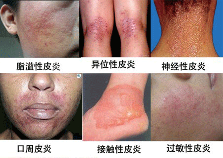 【费用】专家详解治疗皮炎的费用