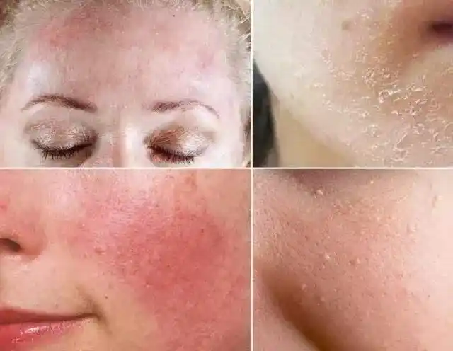 红血丝,干燥脱皮,角质层薄该如何护肤?3招做好皮肤管理!