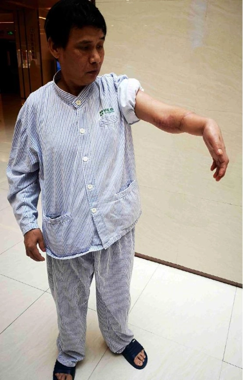 患者李先生展示断肢再植成活的左手臂(韩希 摄)根据褚晓朝主任介绍,李