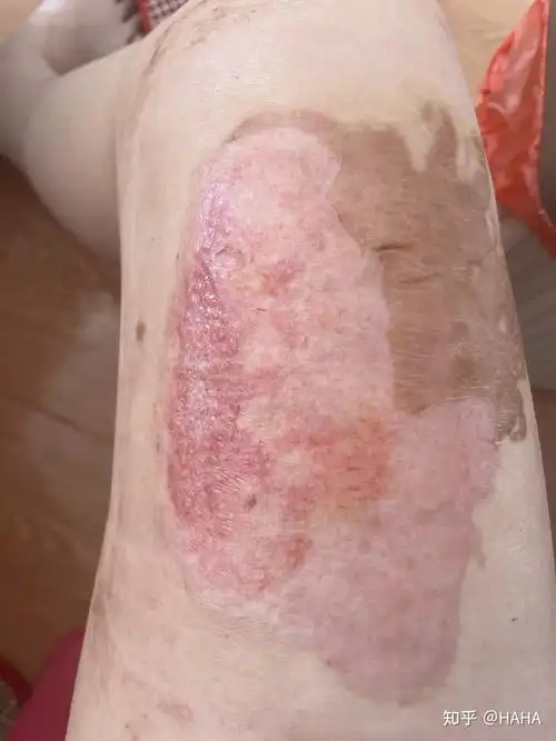 烫伤自我在家换药过程 - 知乎