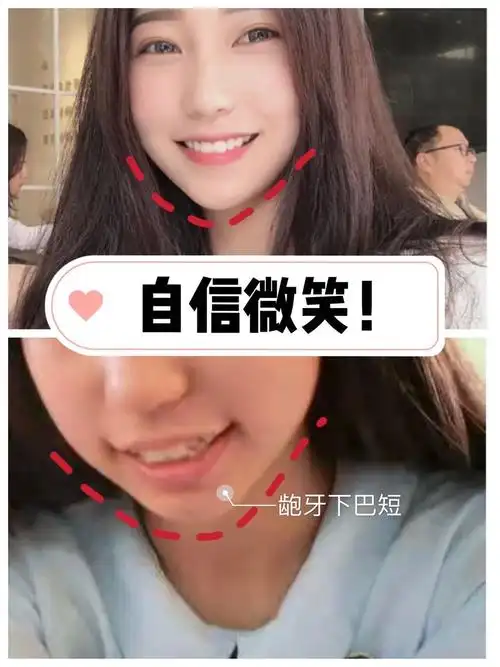 龅牙 虎牙牙齿矫正拔了四颗!