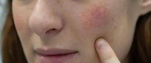 秋冬皮肤出现干燥,紧绷,起皮?警惕是这里出了问题!