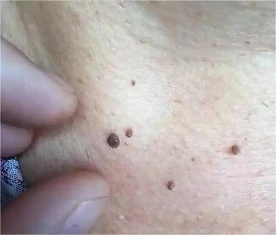 颈部有两种常见的疣,一种是丝状疣,由病毒感染和人乳头瘤病毒感染引起