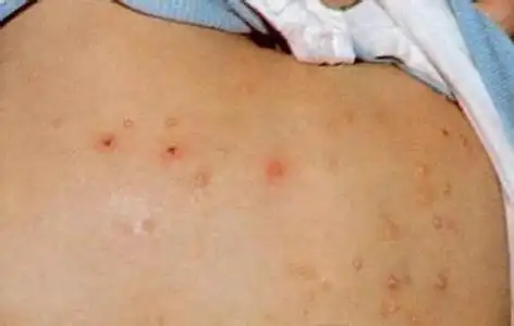 艾滋病皮疹图片
