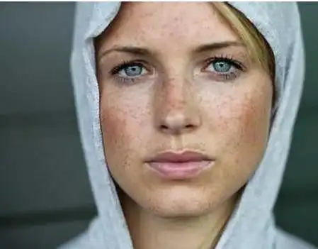 柠檬祛斑还美白?祛斑误区你还要多久走出