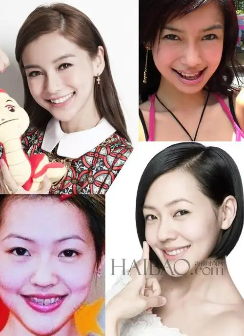 牙齿漂亮有多重要?一起来盘点那些整过牙就变仙女,王子的明星们.